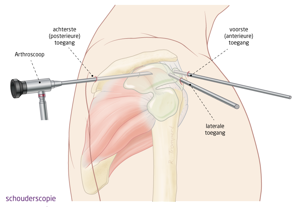 bursitis subacromialis injectie